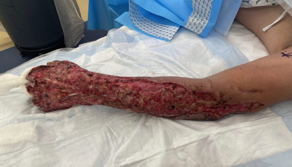 Salud Pública investiga supuesta muerte de una persona debido a “bacteria devorada de carne” 