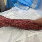 Salud Pública investiga supuesta muerte de una persona debido a “bacteria devorada de carne” 